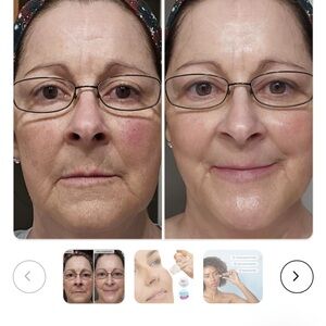 The Qure microneedling system